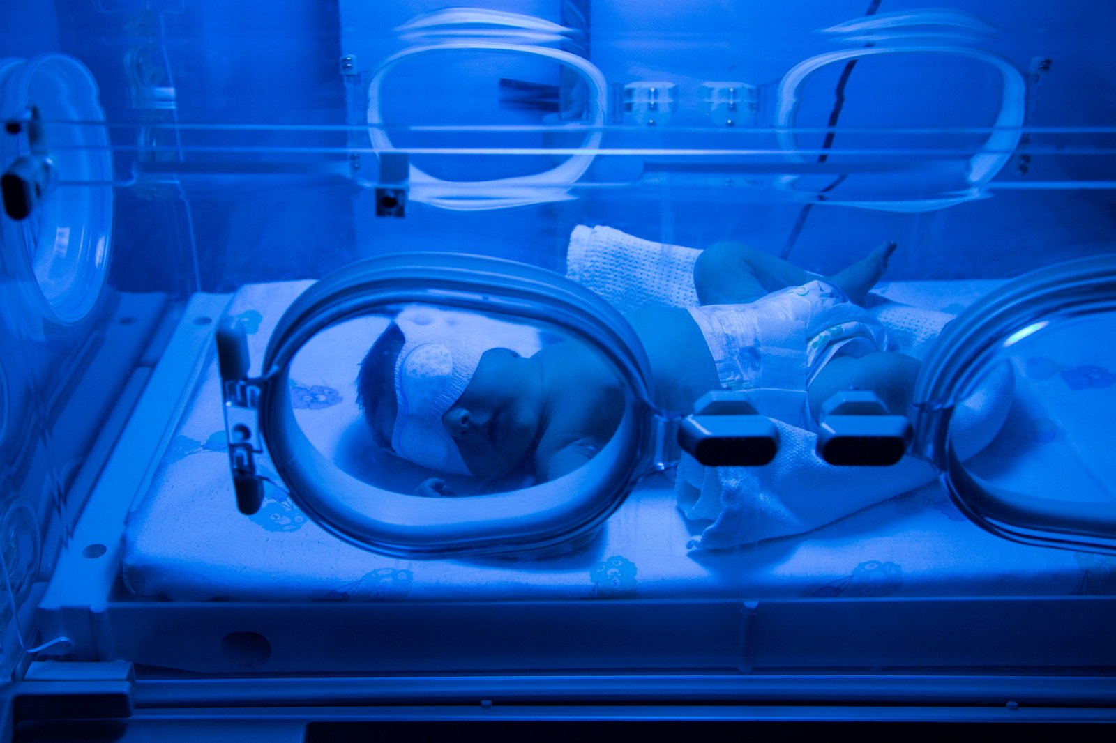 Falta de tratamento para icterícia neonatal na rede pública faz MPRN acionar a Justiça em Pau dos Ferros